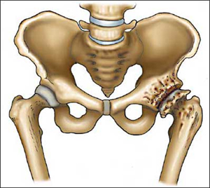 Hip Osteoarthritis