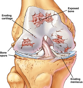 Knee Osteoarthritis