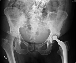 Pre-op Severe rapidly destructive Osteoarthritis