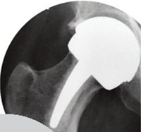 Proximal Epiphyseal Replacement